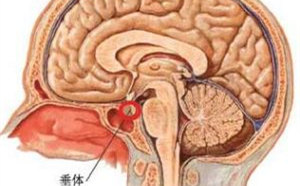 垂体瘤复发后怎么办?