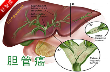 胆管癌手术后的饮食